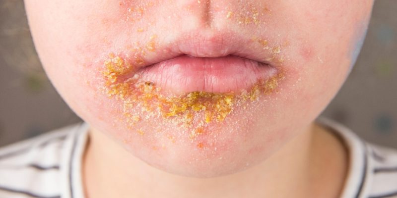 Impetigonew_share Impetigonew_share