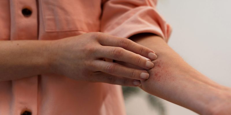 person-dealing-with-rosacea person-dealing-with-rosacea